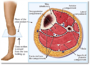 Compartment Syndrome: Appreciating Atypical Lower Leg Pain in