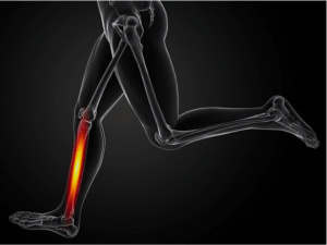 Are Shin Splints hurting your Run? Relieve Pain Today